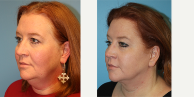 45-54 year old woman treated with Facelift - 48 year old woman following a facelift and necklift. Notice her more youthful and lifted facial and neck appearance as well as improved definition of her chin and jawline.