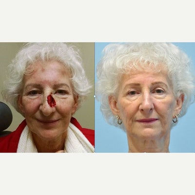 65-74 year old woman treated with Facial Reconstructive Surgery - Woman with a large nasal defect following Mohs excision of a skin cancer.  This is after reconstruction with a forehead flap and septal cartilage graft to maintain her nasal airway.  There is essentially no visible scarring and the nose is very symmetric.