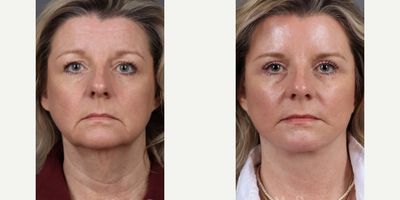 Woman treated with Facelift, Eyelid Surgery - Delivering natural, rejuvenated beauty. Before and after results of a facelift & Upper Blepharoplasty performed by Dr. Marotta