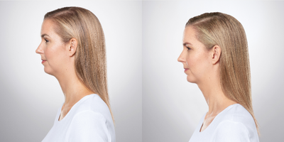25-34 year old woman treated with Kybella - After three treatments of Kybella