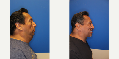 45-54 year old man treated with Neck Lift - Result 1 year after Direct Neck Lift and Chin implant.