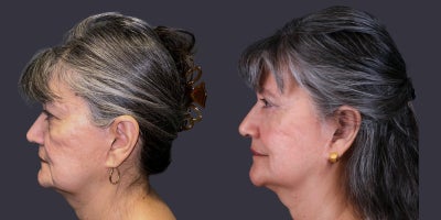 65-74 year old woman treated with Eyelid Surgery, CO2 Laser, Facial Fat Transfer, ActiveFX - This 69 year old woman presented requesting improvement in her tired eyes. She had upper eyelid blepharoplasty, lower eyelid blepharoplasty with fat transposition, and CO2 laser resurfacing around the eyes.