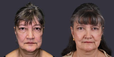 65-74 year old woman treated with Eyelid Surgery, CO2 Laser, Facial Fat Transfer, ActiveFX - This 69 year old woman presented requesting improvement in her tired eyes. She had upper eyelid blepharoplasty, lower eyelid blepharoplasty with fat transposition, and CO2 laser resurfacing around the eyes.