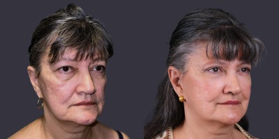 65-74 year old woman treated with Eyelid Surgery, CO2 Laser, Facial Fat Transfer, ActiveFX - This 69 year old woman presented requesting improvement in her tired eyes. She had upper eyelid blepharoplasty, lower eyelid blepharoplasty with fat transposition, and CO2 laser resurfacing around the eyes.