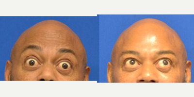 55-64 year old man treated with Daxxify - Daxxify injected to the foreheadInjected by Scarlet Lamb, PA-C