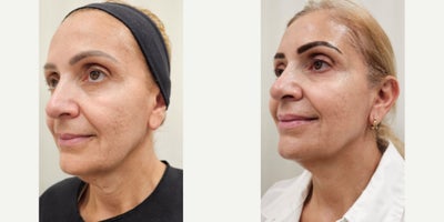 55-64 year old woman treated with Sylfirm X, Alastin Skincare, Ultherapy - Tailored Treatment Plan to treat skin sagging, specially on her neck, acne scars. Patient received Ultherapy session on jowls and upper neck. After 2 months, 2 sessions of our SylfirmX protocol on face and neck, combined with Benev Exosomes and Alastin Skincare. One month between the 1st and 2nd session. Pictures were taken just before her 3rd session.