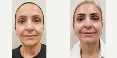 55-64 year old woman treated with Sylfirm X, Alastin Skincare, Ultherapy - Tailored Treatment Plan to treat skin sagging, specially on her neck, acne scars. Patient received Ultherapy session on jowls and upper neck. After 2 months, 2 sessions of our SylfirmX protocol on face and neck, combined with Benev Exosomes and Alastin Skincare. One month between the 1st and 2nd session. Pictures were taken just before her 3rd session.