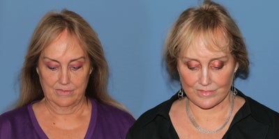Woman treated with Deep Plane Facelift - Woman treated with Deep Plane Facelift