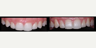 17 or under year old woman treated with Gum Lift - Permanent gum lift to reveal better proportioned teeth