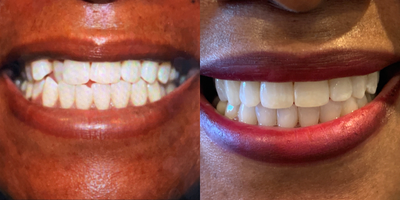 35-44 year old woman treated with Clear Braces & KOR whitening - You shouldn't have to wait 2 years for straight teeth. Six Month Smiles Clear Braces are designed to straighten your teeth in about 6 MONTHS.Six Month Smiles is generally less expensive than traditional braces or aligners due to shorter treatment time.