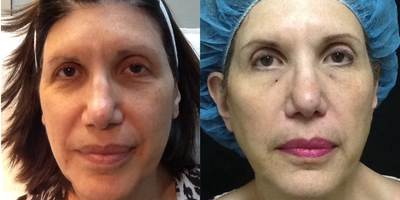 65-74 year old woman treated with Pelleve - Patient was unhappy with laxity of her skin.