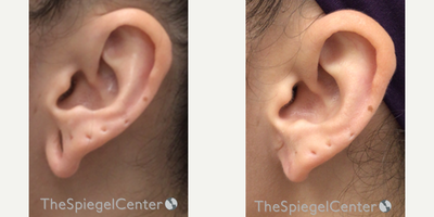 25-34 year old woman treated with Earlobe Repair - Earlobe Repair