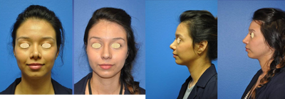Latin American / Ethnic nasal revision - This young women had a prior rhinoplasty.  She was not satisfied with the irregular tip and nostril shape.  She was also unhappy with her indistinct profile.  Additionally she suffered from breathing obstruction.  She underwent a revision surgery that involved cartilage grafting from the rib.  The procedure was open. She had spreader grafts, alar rim grafts, alar baton grafts, and a columellar strut graft.  The nostrils were also resized with a marginal and alar base reduction.