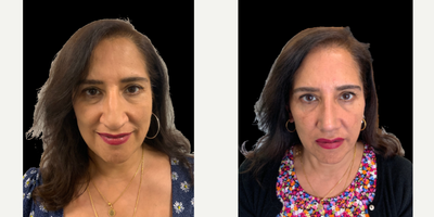 45-54 year old woman treated with Rhinoplasty - This patient who is from India requested a rhinoplasty to reduce a dorsal hump and droopy tip. I performed an ultrasonic rhinoplasty to reduce the dorsal hump/ This technique uses a device called a piezotome to sculpt the nasal bones and avoids hammers and chisels. This technique is mor precise and enhances the recovery with reduced bruising nd swelling. The tip needed supporting to correct a droopy tip. From the from view the bulbous tip has been refined and the dorsal irregularities refined.All of this is performed in a manner which suits her ethnicity and the final result softens her face and whilst enhancing her beautiful facial features.