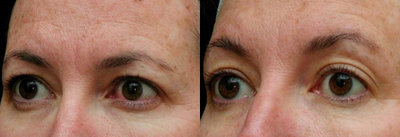 45-54 year old woman treated with Thermage - 1 month after Thermage eyes