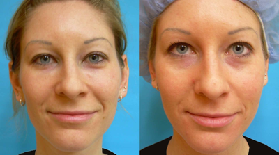 Under-Eye Filler Treatment - 
	Filler treatment reduces the aging effects of hollows under the eyes

