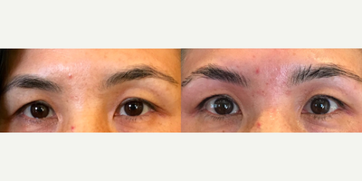 45-54 year old woman brow lift with ThermiSmooth - 48 year old woman desire brow lift and skin tightening