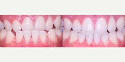 Man treated with Invisalign - Patient presented with a chief complaint of displeasure with his underbite which made it difficult to chew properly and was leading to his gums receding. Invisalign treatment took 15 months to complete. Patient was so pleased with his new smile and his ability to chew food properly.