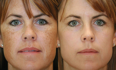 25-34 year old woman treated with BroadBand Light (BBL) - Before & After 2 treatments