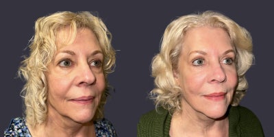 65-74 year old woman treated with ActiveFX, CO2 Laser, Eyelid Surgery, Laser Resurfacing - This 70 year had an upper and lower eyelid blepharoplasty surgery including CO2 laser resurfacing around the eyes. She is 5'6 tall and weighs 195 pounds. Her results are shown 6 months after surgery.