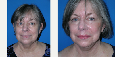 65-74 year old woman treated with upper and lower eyelid surgery - She had upper eyelid skin removed as well as lower eyelid fat. She also had a facelift