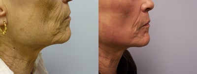 Ablative Laser Resurfacing - 
	Patient underwent ablative CO2 laser treatment. Photos taken 6 weeks after procedure.&nbsp;
