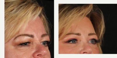 55-64 year old woman treated with Eyelid Surgery, Brow Lift - 3 months out from brow lift and upper blepharoplasty for our beautiful patient with a history of bell's palsy. Thank you to her for allowing us to share!