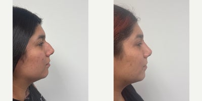 25-34 year old woman treated with Rhinoplasty - 6 weeks after a rhinoplasty