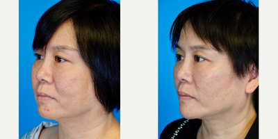 45-54 year old woman treated with Buccal Fat Removal - 48 year old who had a buccal fat removal and mini facelift