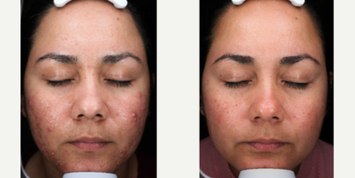 25-34 year old woman treated with AviClear - 25-34 year old woman treated with AviClear