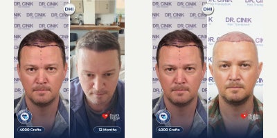 35-44 year old man treated with DHI Hair Transplant, Hair Loss Treatment, Hair Transplant - 4000 grafts DHI