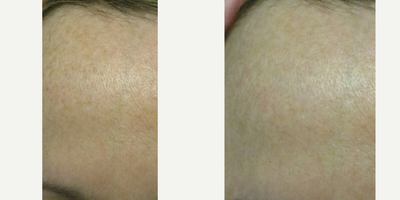 45-54 year old woman treated with Sclerotherapy - 47-year-old female before and after 3 fotofacial (photofacial) skin rejuvenation treatments. Notice the right forehead improvement. Normally the packages is 5 treatments but the patient was happy after 3 and stopped. The patient was a sun worshiper and spent a lot of time outdoors during her youth but was now bothered by the worsening hyperpigmentation. She refused to be on skin lightening products. Everyone can benefit from skin rejuvenation treatments and we do this all over the body. There is no downtime.