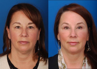 Bilateral upper and lower blepharoplasties with submentoplasty - Female patient with concerns of premature aging and tired appearance around eyes in addition to neck laxity and fat accumulation. The patient underwent upper and lower eyelid surgery as well as submentoplasty and sculpting liposuction.