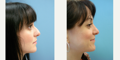 25-34 year old woman treated with Rhinoplasty - This patient was dissatisfied with the appearance of her nose and elected to undergo rhinoplasty with Dr. Wolf to improve her features.