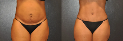 Woman treated with Tummy Tuck - Woman treated with Tummy Tuck