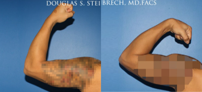 25-34 year old man treated with Bicep Implants - 25-34 year old man treated with Bicep Implants