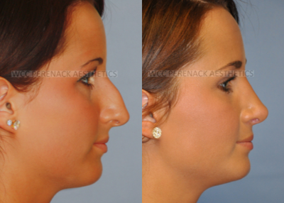 18-24 year old woman treated with Rhinoplasty - Rhinoplasty (nose surgery) is a procedure to help improve the appearance and function of your nose. Some people want a different size or shape. Others wish to repair damage caused by an injury, and some just want to breathe easier.