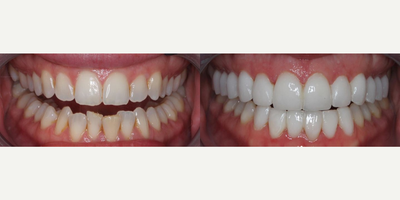 Woman treated with Tooth Repair - Woman treated with Tooth Repair through 12 upper minimal and no prep veneers as well as 6 lower veneers, shown immediately after the treatment. Her smile was also broadened, gum asymmetry was corrected using laser as well as some crowding on the lowers.