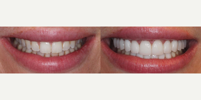 Woman treated with Tooth Repair - Woman treated with Tooth Repair through 12 upper minimal and no prep veneers as well as 6 lower veneers, shown immediately after the treatment. Her smile was also broadened, gum asymmetry was corrected using laser as well as some crowding on the lowers.