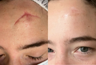 35-44 year old woman treated with Scar Removal - Mixto fractional Co2 laser resurfacing and fillers were used to remove indented and unsightly scars from trauma (fall). Several sessions over 3 months were needed. Each time the skin heals over 5-7 days and the scars look about 20-30% better.