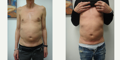 55-64 year old man treated with Liposonix - Liposonix treatment of the abdomen
