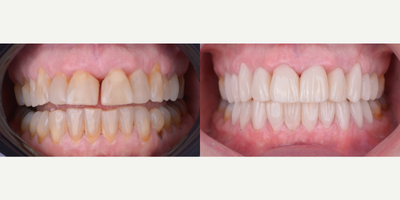 45-54 year old woman treated with Porcelain Veneers, Lumineers, Smile Makeover, Da Vinci Veneers - 20 Porcelain Veneers color Bleach 2, texture and digital design.
