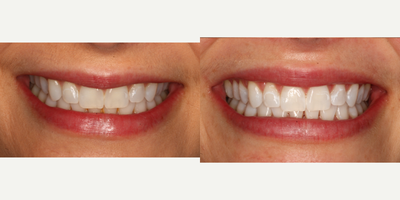 25-34 year old woman treated with Zoom Whitening - This patient desired whiter teeth. Zoom Teeth Whitening was used to achieve brighter, whiter teeth. Patient was very happy with results.