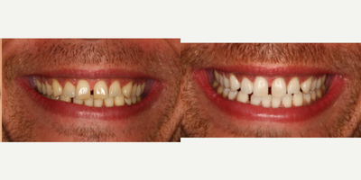 35-44 year old man treated with Zoom Whitening - This patient desired whiter teeth. Zoom Teeth Whitening was used to achieve brighter, whiter teeth. Patient was very happy with results.