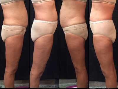 55-64 year old woman treated with UltraShape Power - Lost 3 Inches after 3 Treatments in 12 Weeks time!