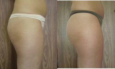 TriPollar - 
	Cellulite improvement after 9 treatments. Photos supplied by manufacturer, Pollogen Ltd, All Rights Reserved.
