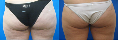 TriPollar - 
	Buttocks skin tightening and fat reduction after 8 treatments. Photos supplied by manufacturer, Pollogen Ltd, All Rights Reserved.
