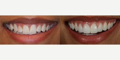 Woman treated with Porcelain Veneers - The goal here was pretty and natural. With gum work, we were able to change the gingival architecture of the front teeth. So important because the gums frame the veneers! We established better proportions for her teeth and smile and intentionally built some very slight imperfections into 4 veneers to create a very natural look.