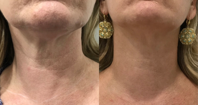 45-54 year old woman treated with Plasma Pen - This patient was experiencing laxity in the neck and submental region. Tone, texture and laxity has been greatly improved with one Plasma Pen treatment to the full neck.