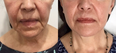 65-74 year old woman treated with Plasma Pen - This woman has moderate laxity to her jowls, jawline and nasal labial folds. We treated her with Plasma pen to those areas. This photo shows her at the 6 week mark however further tightening will happen over the next 10 weeks.